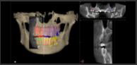 CT撮影によるDICOMデータ（骨の立体画像）