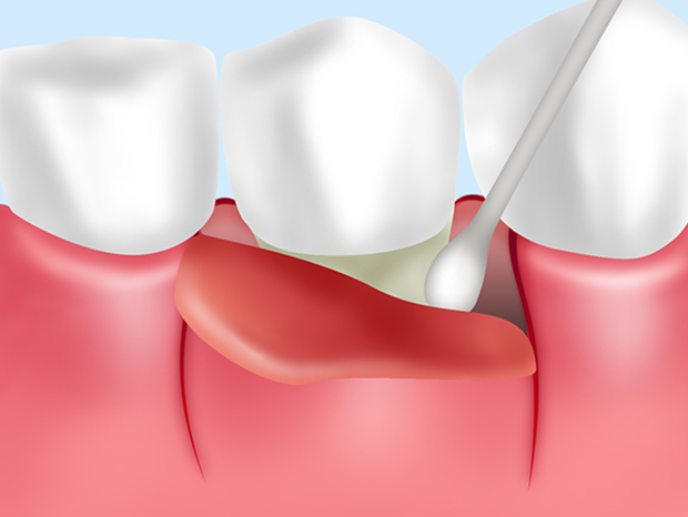 歯周病外科治療