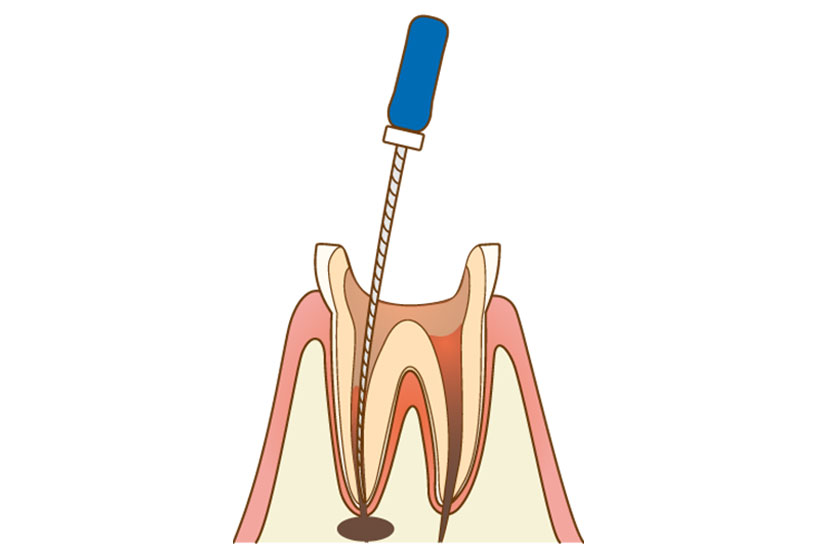 感染部位の除去｜アール歯科・矯正歯科クリニック