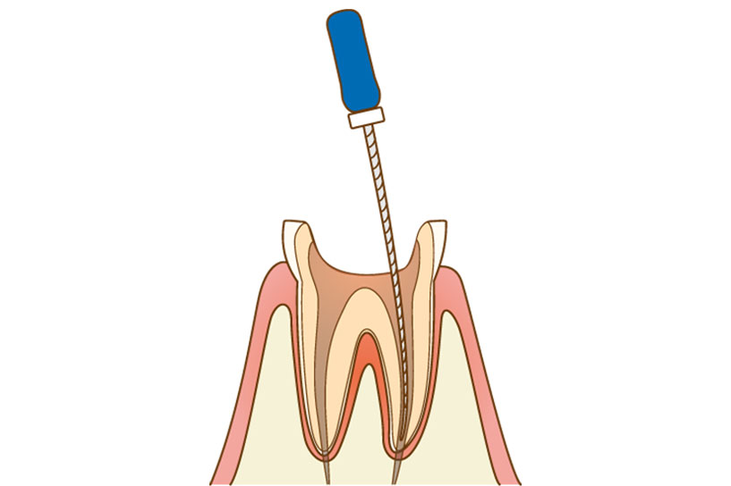 根管の清掃と消毒｜アール歯科・矯正歯科クリニック