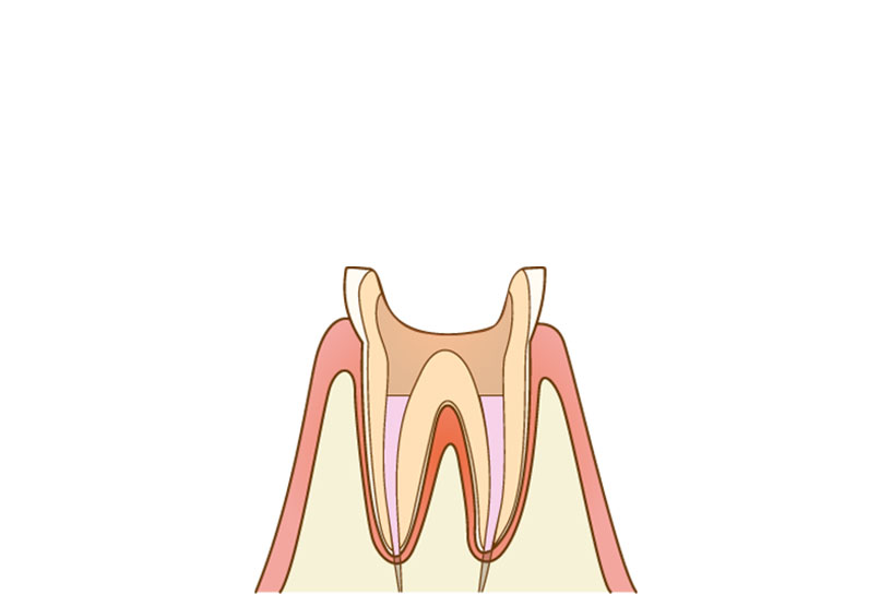 根管の充填｜アール歯科・矯正歯科クリニック