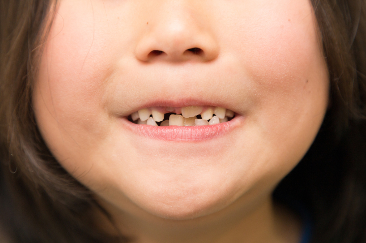 マイオブレースで治療できない歯並びの症例