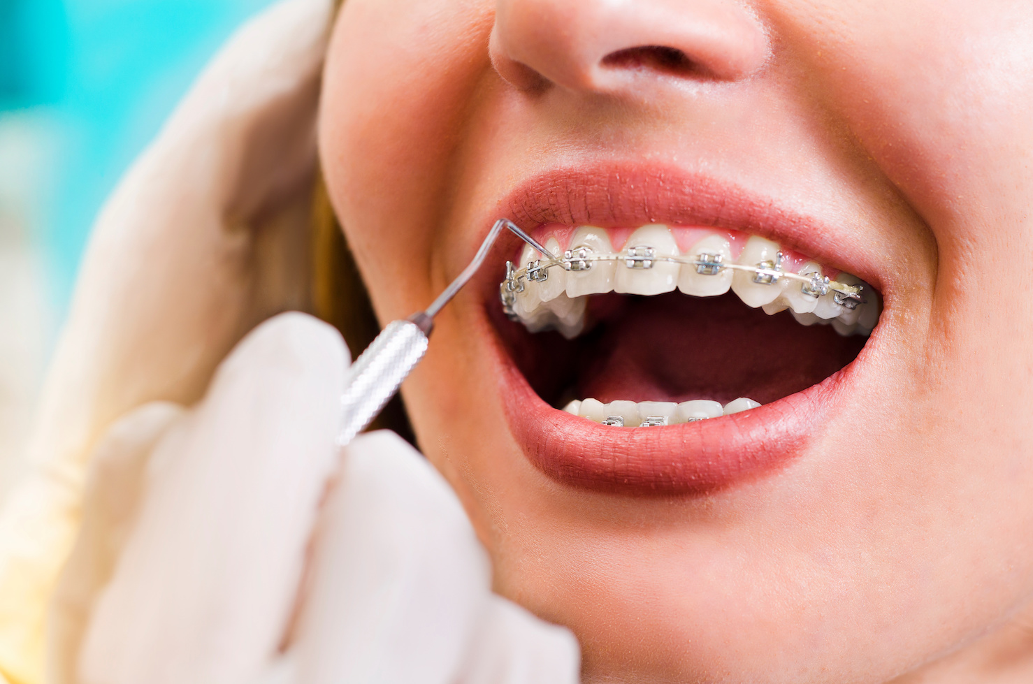Closeup young woman checking her braces, smiling