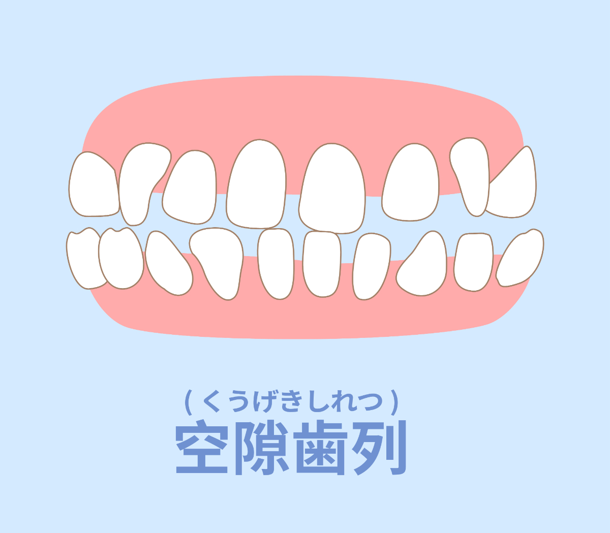 空隙歯列(くうげきしれつ)のイラスト