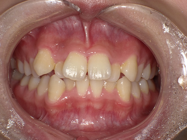 img-case13-bf