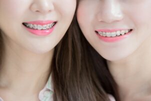 ワイヤー矯正とリテーナーをした女性たち