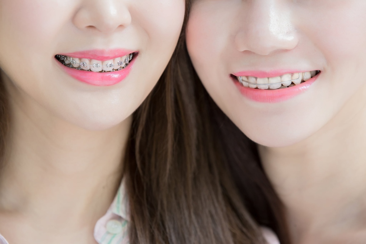 ワイヤー矯正とリテーナーをした女性たち